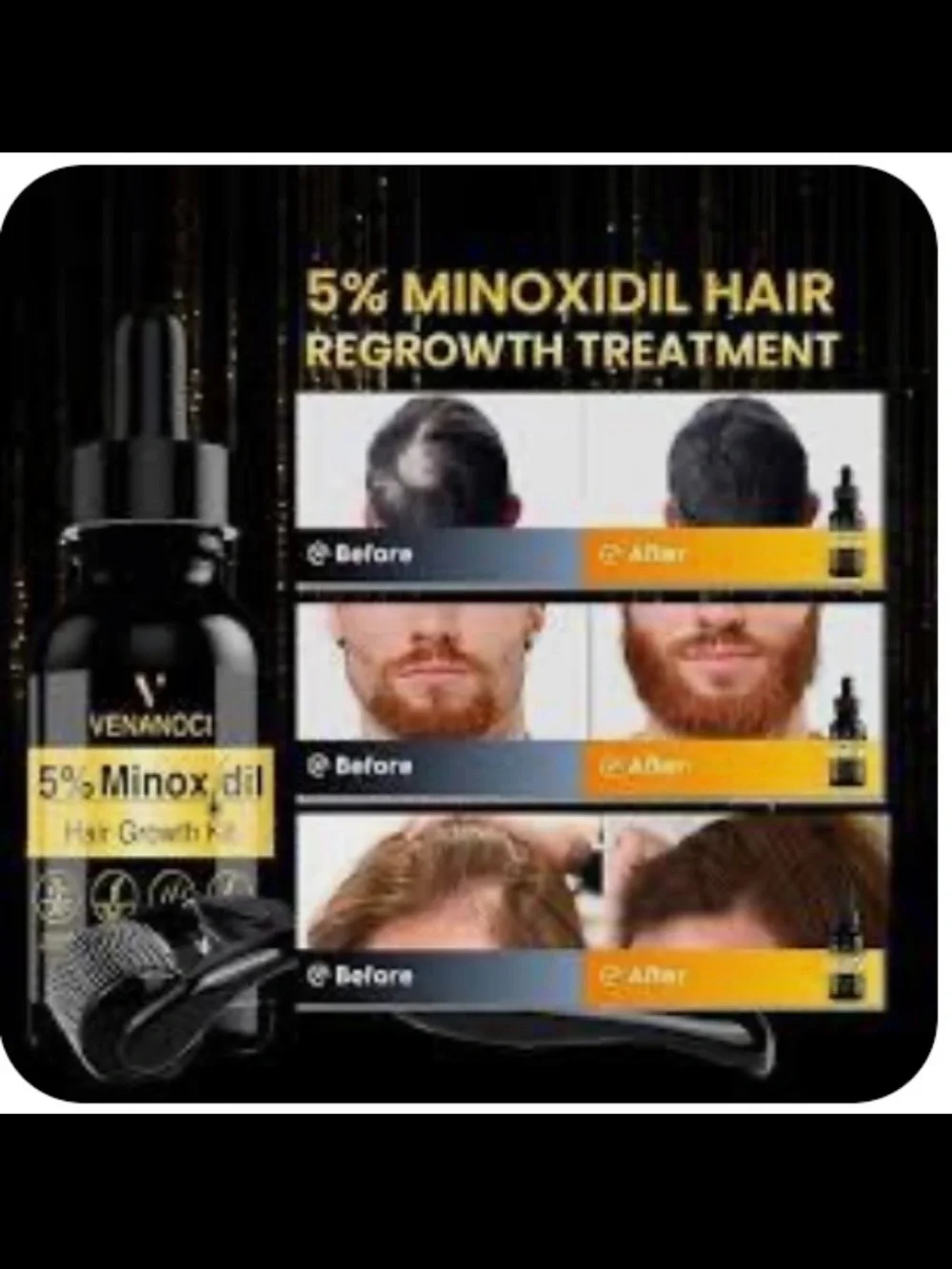 5% Minoxidil hair & Beard Growth Kit – Black & Yellow